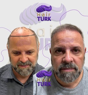 Before & after FUE hair transplant at HairTurk: elderly bald man to full hair, smiling