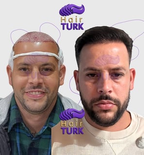 Antes y después de un trasplante capilar FUE en HairTurk: de calvo a todo pelo, sonriendo.