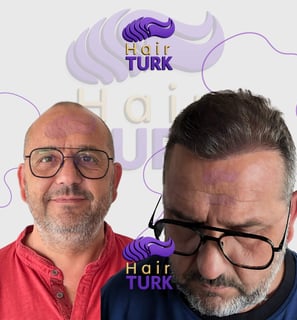 Antes y después de un trasplante capilar FUE en HairTurk: de calvo a todo pelo, sonriendo.