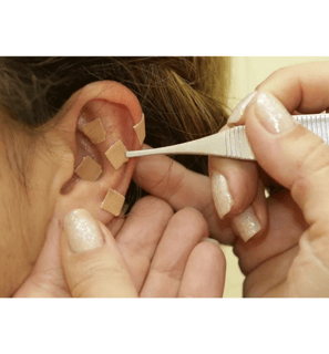 Terapeuta aplicando adesivos de auriculoterapia na orelha da paciente com a pinça