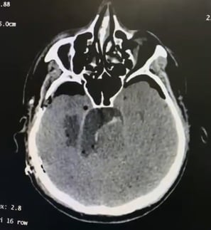 Post-operative CT scan showing subtotal removal of the tumor