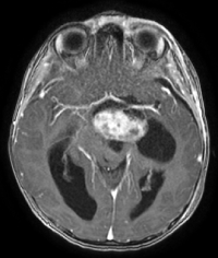 Ressonância de criança com cefaleia e volumoso tumor antes da cirurgia no cérebro.