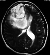 Ressonância de mulher de 48 anos com crises epilépticas e um volumoso tumor cerebral.