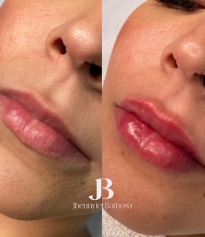 antes e depois preenchimento labial