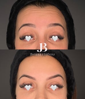 antes e depois botox