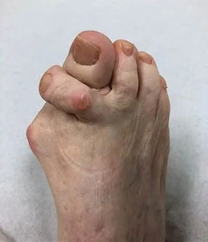 Hallux Valgo