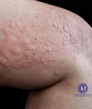 Urticaria Homeopathic Treatment