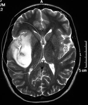 Ressonância de paciente epiléptica com tumor na ínsula direita antes da cirurgia no cérebro.