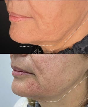 antes e depois harmonização facial