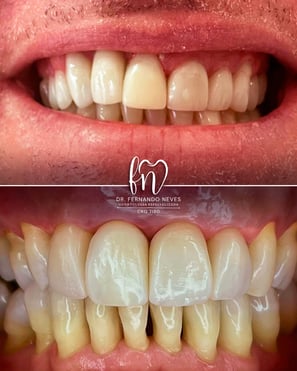 a before and after image of dental treatment