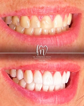 a before and after image of dental treatment