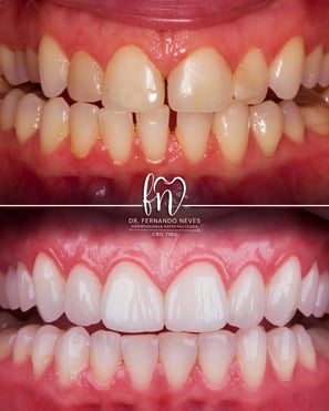 a before and after image of dental treatment