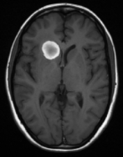 Ressonância de paciente epiléptica antes da cirurgia no cérebro.