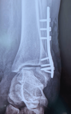 Placa para Peroné Distal