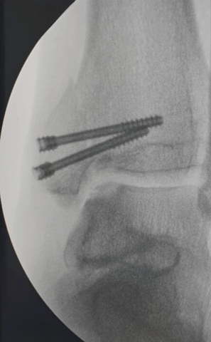 Tornillos canulados tipo Herbert