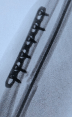 Placa recta y clavo TEN