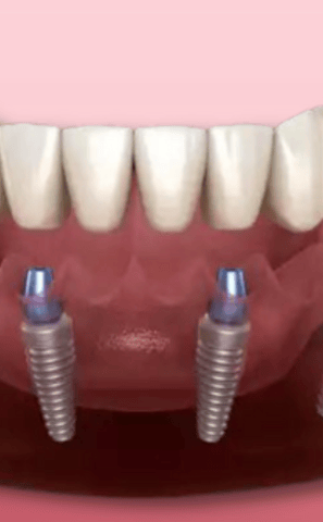 a dental implanting implanting teeth and implants