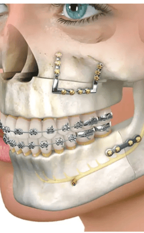 a dental implanting implanting teeth and implants