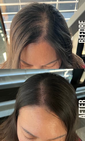 a hair density treatment on a woman with thinning hair using SMP to make her hair look thicker