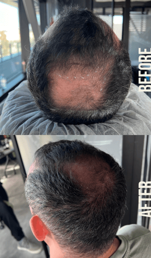 Using S&P hair loss treatment on man with bald spot before and after