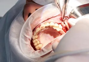 implantes con cirugia oral en sevilla