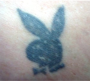 electrolysis-and-tattoos