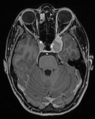 Ressonância de paciente com dor na testa e tumor no seio cavernoso antes da cirurgia no cérebro.