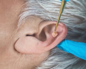 La réflexologie auriculaire