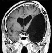 Ressonância após a cirurgia com remoção total do tumor. Ele ficou curado.
