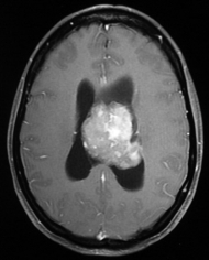 Ressonância de paciente com cefaleia e vômitos com volumoso tumor antes da cirurgia no cérebro.