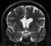 Ressonância após a cirurgia no cérebro com remoção do cisto colóide e resolução da hidrocefalia.