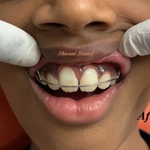 closing of milk teeth spacing by removable braces