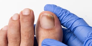 Tratamento de Micose nas Unhas em Joinville | Essence Podologia e Bem Estar