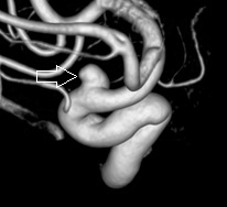 Angiografia digital 3D. A seta indica o aneurisma cerebral.