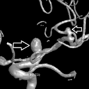 Angiografia digital 3D projeção perfil. A seta indica o aneurisma cerebral.