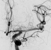 Angiografia digital projeção frontal após cirurgia no cérebro e clipagem do aneurisma cerebral. 