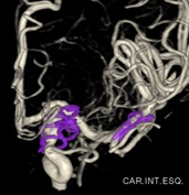 Angiografia digital 3D após a clipagem do aneurisma cerebral.