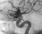 Angiografia digital projeção perfil após a clipagem do aneurisma cerebral.