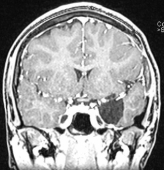 Ressonância após a cirurgia no cérebro com remoção total do tumor. Ela ficou curada da epilepsia.