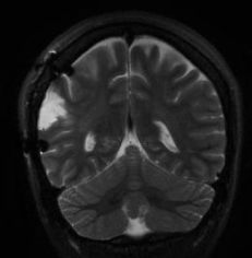 Ressonância após a retirada total do tumor. A paciente ficou livre de crises de epilepsia.