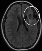 Ressonância de menino de 16 anos com epilepsia desde os 13, com sequela de isquemia frontal esquerda