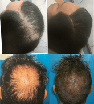 Result of taking TruVarin for Hair growth