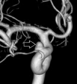Angiografia digital reconstrução 3D mostrando o aneurisma cerebral.