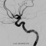 Angiografia projeção perfil após a cirurgia no cérebro para a clipagem de aneurisma cerebral.
