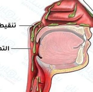 تنقيط والتهاب