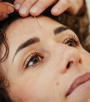 aculifting