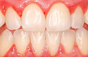 inflammation gencives gingivite