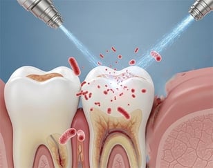Soigner infection bouche jet avec un jet dentaire ozone Aquolab hygiene-precision.com
