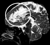 Ressonância de menina de 3 anos com epilepsia há 2 anos, sequela de abscesso cerebral (círculo).