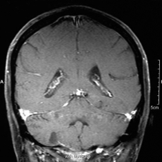 Ressonância magnética após a cirurgia com remoção total do tumor.